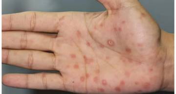 La sífilis no da tregua en Salta: crecen los casos y advierten por controles urgentes