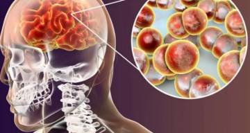 Preocupación por la meningitis: aumentaron los casos y advierten sobre la baja vacunación